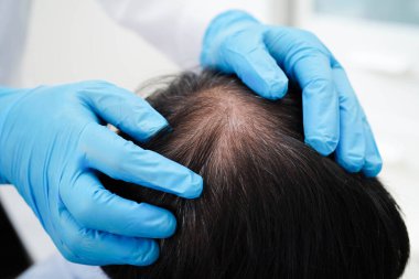 Doktor cesur bir kafa, saç dökülmesi sağlık problemi.