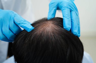 Doktor cesur bir kafa, saç dökülmesi sağlık problemi.