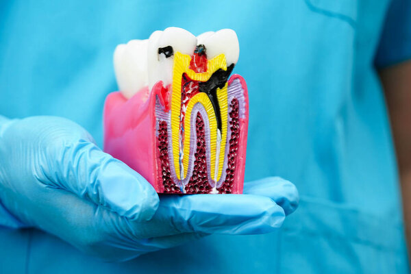 Dentist holding dental implant, artificial tooth roots into jaw, root canal of dental treatment, gum disease, teeth model for dentist.