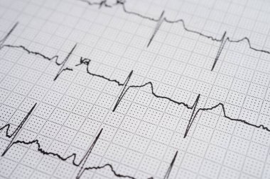 Elektrokardiyogram (EKG), kalp dalgası, kalp krizi, kardiyogram raporu.