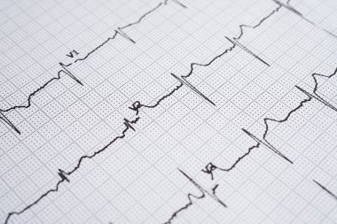 Elektrokardiyogram (EKG), kalp dalgası, kalp krizi, kardiyogram raporu.