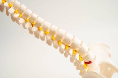 Omurga ve kemik, bel kemiği yerinden oynamış disk parçası, ortopedi bölümünde tedavi için model..