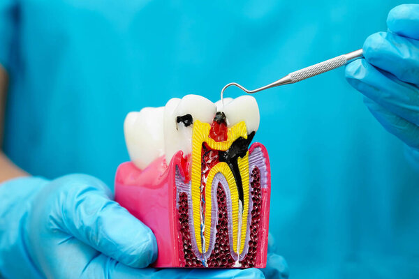 Dentist holding dental implant, artificial tooth roots into jaw, root canal of dental treatment, gum disease, teeth model for dentist.