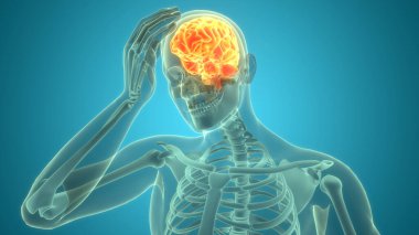 Şiddetli Baş Ağrısı Anatomisi ile İnsan Izdırabının Üç Boyutlu İllüstrasyonu