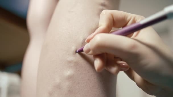 手術のために患者を準備する脚に鉛筆で書く人 — ストック動画