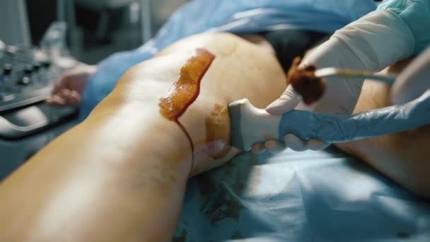 病院の手術室で患者の静脈手術を行う外科医 — ストック動画