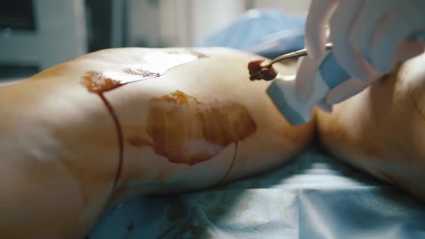 Chirurg Führt Venenoperation Patientin Operationssaal Des Krankenhauses Durch — Stockvideo