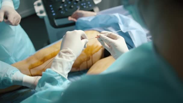 수술실에서 환자에게 수술을 수행하는 외과의사 — 비디오