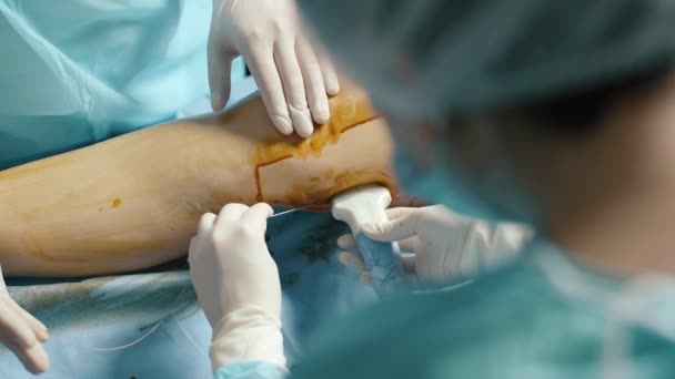 Lekarz Szpitalnej Sukni Wykonujący Operację Żyły — Wideo stockowe