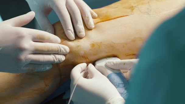 Executando Procedimento Cirúrgico Venoso Uma Clínica Médica — Vídeo de Stock