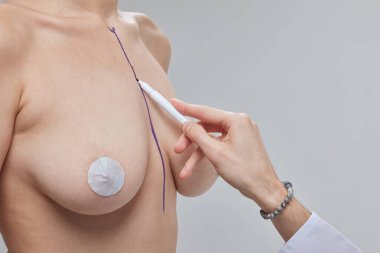 Göğüs büyütme. Closeup Şevval Özçelik Güzellik güzel kadın göğüs cerrahi çizgi çizme eldiven eller. Plastik cerrahi operasyondan önceki göğüsler üzerinde siyah işaretleri ile seksi kadın bedeni. Yüksek çözünürlük