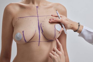 Doktor el çizgileri çiziyor kadın göğsüne, göğüs implantı ameliyat konseptine..