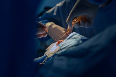 Blepharoplasti, göz kapaklarındaki kusurları düzeltmek için estetik ameliyat göz bölgesini estetik olarak değiştirmek için. Bir klinikte yağ birikintilerinin alınması, bir cerrahi ekip bir operasyon gerçekleştirir.