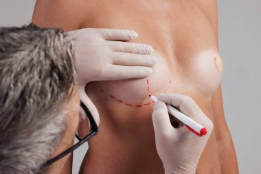 Bir estetik cerrah, göğüs büyütme ameliyatından önce kırmızı kalemle işaretleme uygular. Meme büyütme, güzel göğüs şekli kavramı.