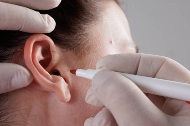 Doktor cerrah Otoplasty operasyonu için hazırlanıyor, Kulak estetiği, çıkıntılı kulakların düzeltilmesi.
