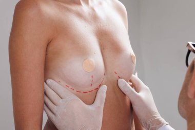 Göğüs büyütme. Kadını açık gri arka plana karşı estetik ameliyata hazırlayan işaretçi doktor, yakın plan.