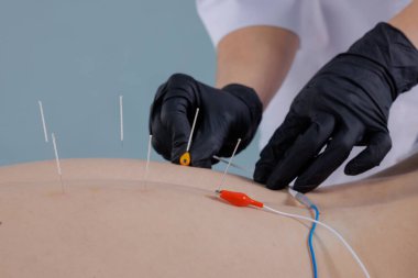 Bir doktor kuru iğne yöntemini kullanarak bir elektromiyomülatörü bir adamın sırtına iğnelerle bağlar. Geleneksel Çin tıbbı akupunktur ağrıyı dindirmek ve iyileşmek için..