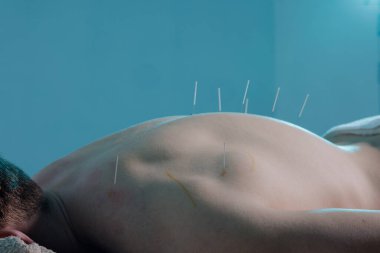 Bir pratisyen hekimin hastanın sırtına ince iğneler batırdığı kuru iğne seansının yakın çekimi. Geleneksel Çin tıbbı akupunktur ağrıyı dindirmek ve iyileşmek için..