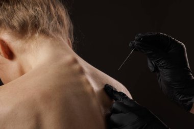 Kuru iğneleme metodu. Sırtın üst kısmında akupunktur terapisi, ağrı kesici, kas gevşemesi ve bütünsel iyileşme tedavisi için ince bir iğne yerleştiren pratisyen..