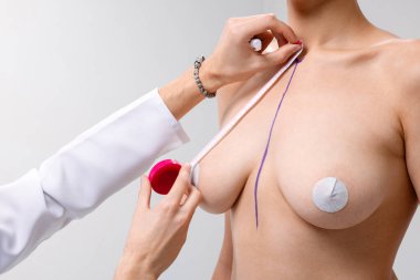 Plastik cerrah, meme implantı ve yükseltme asansörü düzeltme ameliyatından önce kadınların göğsünü işaretledi. 