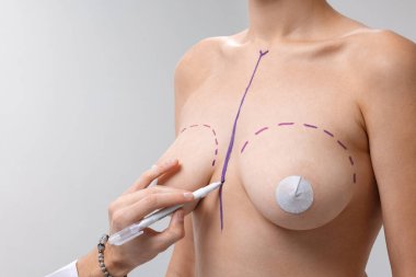 Plastik cerrah göğüs büyütme ameliyatı için ameliyat öncesi çizgiler çiziyor ve meme ucu kapaklarıyla şekil düzeltme yapıyor.