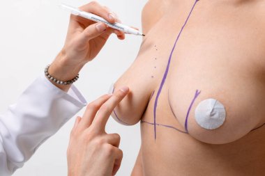 Cerrah, meme büyütme ya da tıbbi hazırlık ve şekil düzeltmesinden önce hastayı işaretledi