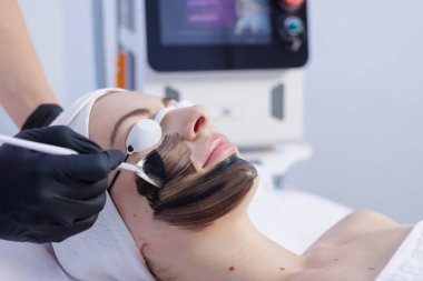 Profesyonel bir güzellik kliniğinde derin cilt temizleme, yaşlanmayı önleme ve gençleştirme için karbon lazer yüz soyma prosedürü.