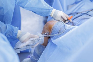 Diz artroskopisi ve PCL rekonstrüksiyonu, mavi steril perdelerde artroskop ve kanül olduğunu gösteriyor. Minimum invazif ortopedik ameliyat.