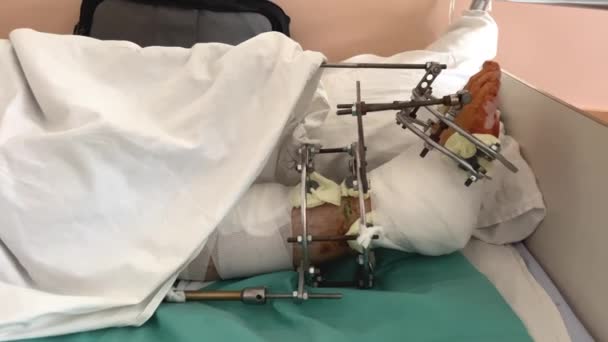 戦争中の飛行機墜落事故の余波イリザロフとの脚の骨折の医学的固定は 病院での骨折の延長を話しました ウクライナでの戦争ロシアのテロリスト — ストック動画