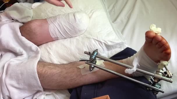 Aftermath War Plane Crash Accident Medical Fixation Leg Fracture Illizarov — Vídeos de Stock