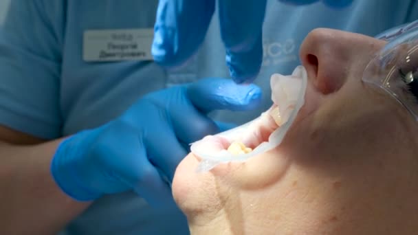 Zahnarztpraxis Arzt Blauen Handschuhen Nahaufnahme Korrigiert Frauenmund Mit Retraktor Oder — Stockvideo