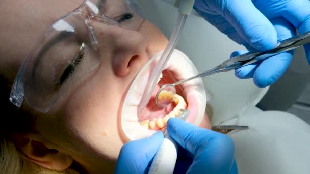 Makro Fotoğrafçılık Diş Üzerinde Yanak Açıcı Desteğiyle Hastaların Ağız Temizleme — Stok video