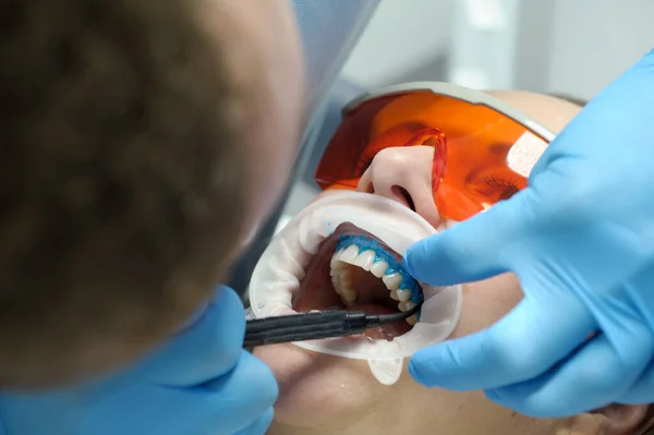 liquid cofferdam to isolate the gums from action of a bleaching agent optragat rotary spreader close-up of the patients teeth in the process of whitening in the dental clinic blue gloves