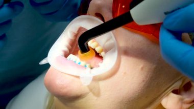 Hastanın yakın dişlerinde fotopolimer lamba kullanarak görülebilir doktor hemşire ders doktoru lambanın diş gözlüklerinin ışığını nasıl açtığını stajyer genç neslin ağız genişleticiyi nasıl engelleyeceğini gösteriyor.