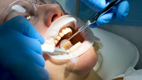 Close Γυναίκα Οδοντιατρική Βούρτσισμα Δόντια Καθαρισμού Αφαιρώντας Πλάκες Πέτρες Σάλιο — Αρχείο Βίντεο