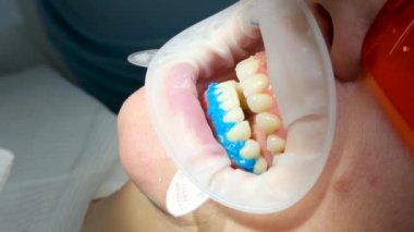 dentistry close-up doctors hand removes hardened liquid rubber dam to isolate gums from active substance of teeth whitening glasses on woman protecting from photopolymer whitening lamp by American