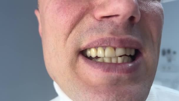 Problemas Dientes Manchas Amarillas Placa Dientes Falsos Necesitan Dentista Hombre — Vídeo de stock