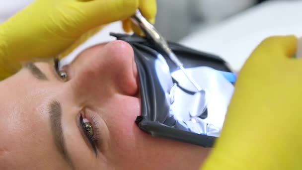 Tratamento Ortodôntico Dentes Com Aparelho Dentário Correcção Mordida Ortodontista Trabalhar — Vídeo de Stock