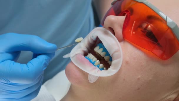歯のエナメル質の色合いを選択する男性歯科医白化前の女性患者への歯のエナメル質の色合いクリニックでの病期分類手順女性は歯科医を訪問病期予約歯のトーンの選択 — ストック動画