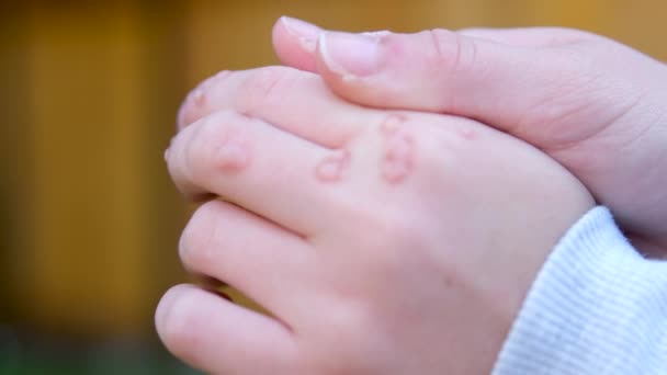 Mão Com Verruga Homem Pele Closeup Mãos Jovem Adolescente São — Vídeo de Stock