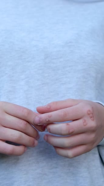 Hand Mit Warzenmann Haut Nahaufnahme Hände Von Jungen Teenager Mädchen — Stockvideo