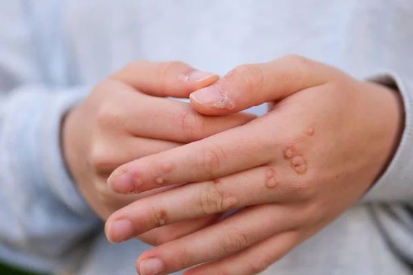 stock image Hand with wart man skin closeup hands of young teenage girl are strewn with warts a lot of papillomas viral infection on hands touch scratching consider near nail viral infection growths on fingers