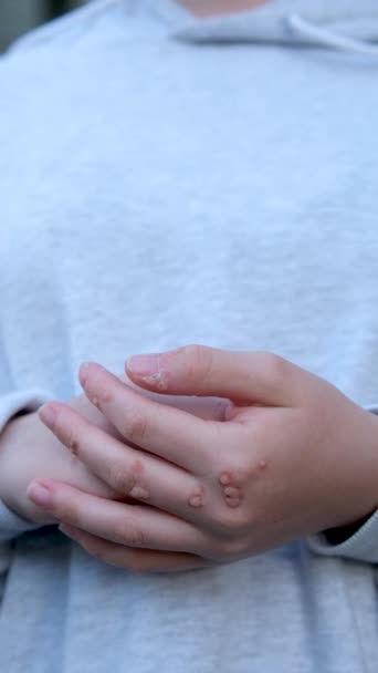 Рука Бородавкой Человек Кожи Крупным Планом Руки Молодой Девушки Подростка — стоковое видео