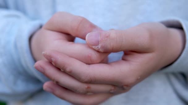Ręka Brodawki Człowieka Skóry Zbliżenie Ręce Młodej Nastolatki Rozrzucone Brodawki — Wideo stockowe