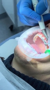 Steril eldiven diş kliniği. Bir erkek doktor başka bir adamın dişlerini fırçalar. Elinde yüksek teknolojili özel bir cihaz vardır.