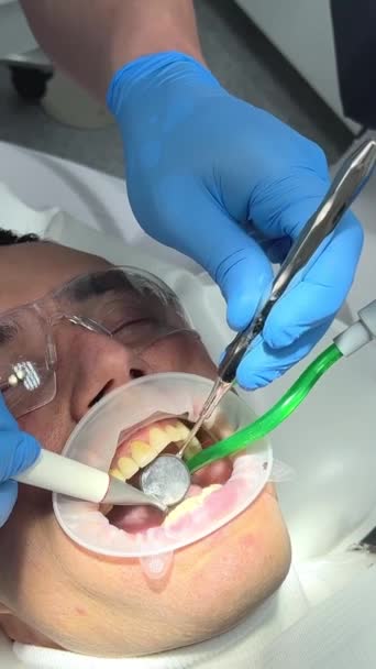 Dentes Limpeza Meia Idade Homem Placa Cálculo Boca Lábio Bochecha — Vídeo de Stock