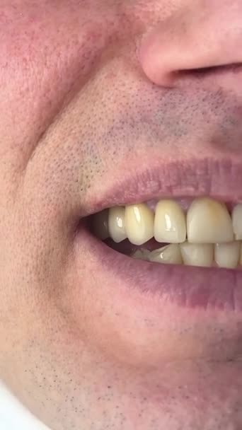 Problemli Dişler Sarı Benekler Sahte Dişler Dişçiye Ihtiyaç Duyar Bir — Stok video