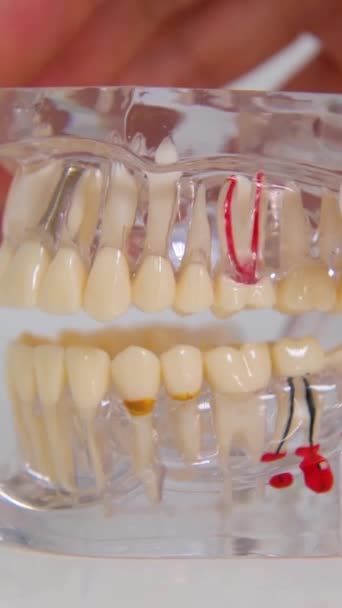 Челюсть Модель Продемонстрировать Стоматологические Заболевания Пластиковые Зубы Женщина Рука Открывает — стоковое видео