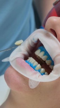 Kadın diş hekimi stomatoloji kliniğindeki temizlik stomatolojisi prosedürünü beyazlatmadan önce diş minesi rengini seçen erkek dişçi. 