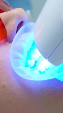 Bir kadının yüzü Poluse + Gelişmiş Beyazlatma Sistemi 'nin Ötesinde, gözlük koruyucu gözlüklü, dişli UV Lazer Beyazlatma Aygıtıyla yakın plan görüntüsü 